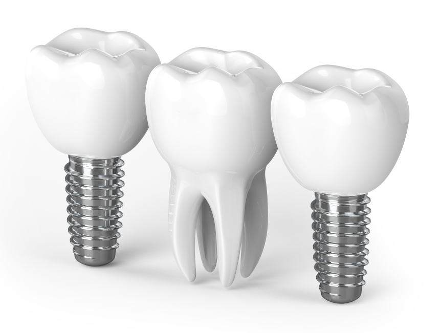 Miami dental implant clinic