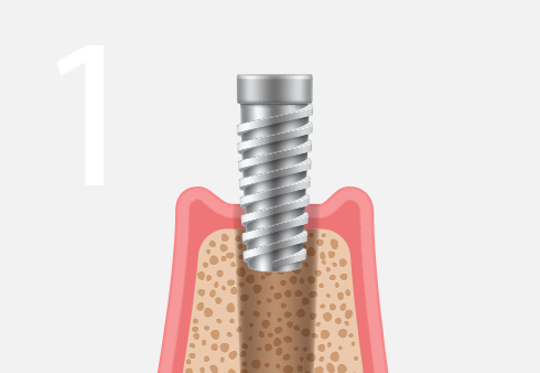 Affordable dental implants