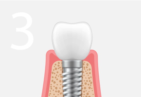 Cosmetic dental implants Miami