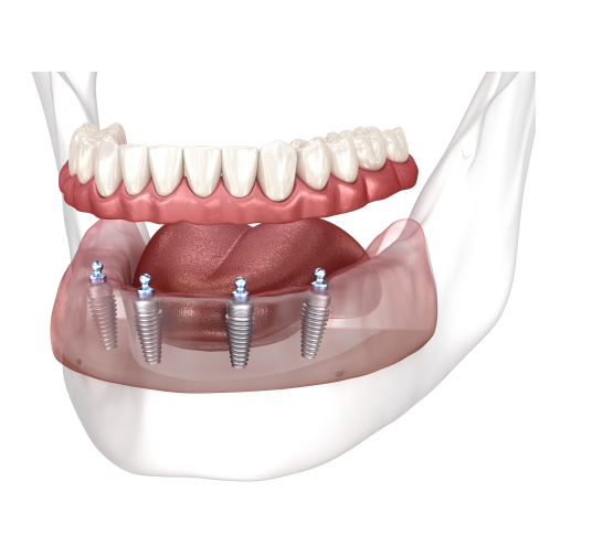 Top dental implant center Miami