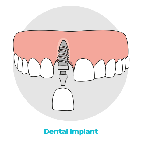 Implant dentistry Miami