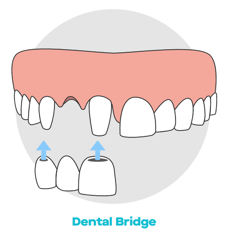 Dental implant services Miami