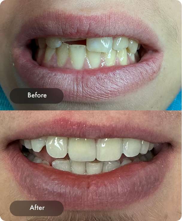 Dental Pearl Miami Before And After Case 1