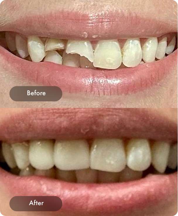 Dental Pearl Miami Before And After Case 4