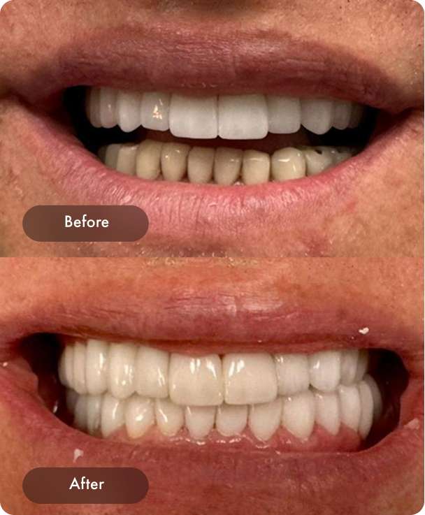 Dental Pearl Miami Before And After Case 5