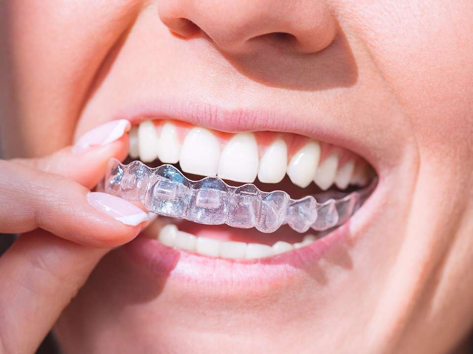 Invisalign