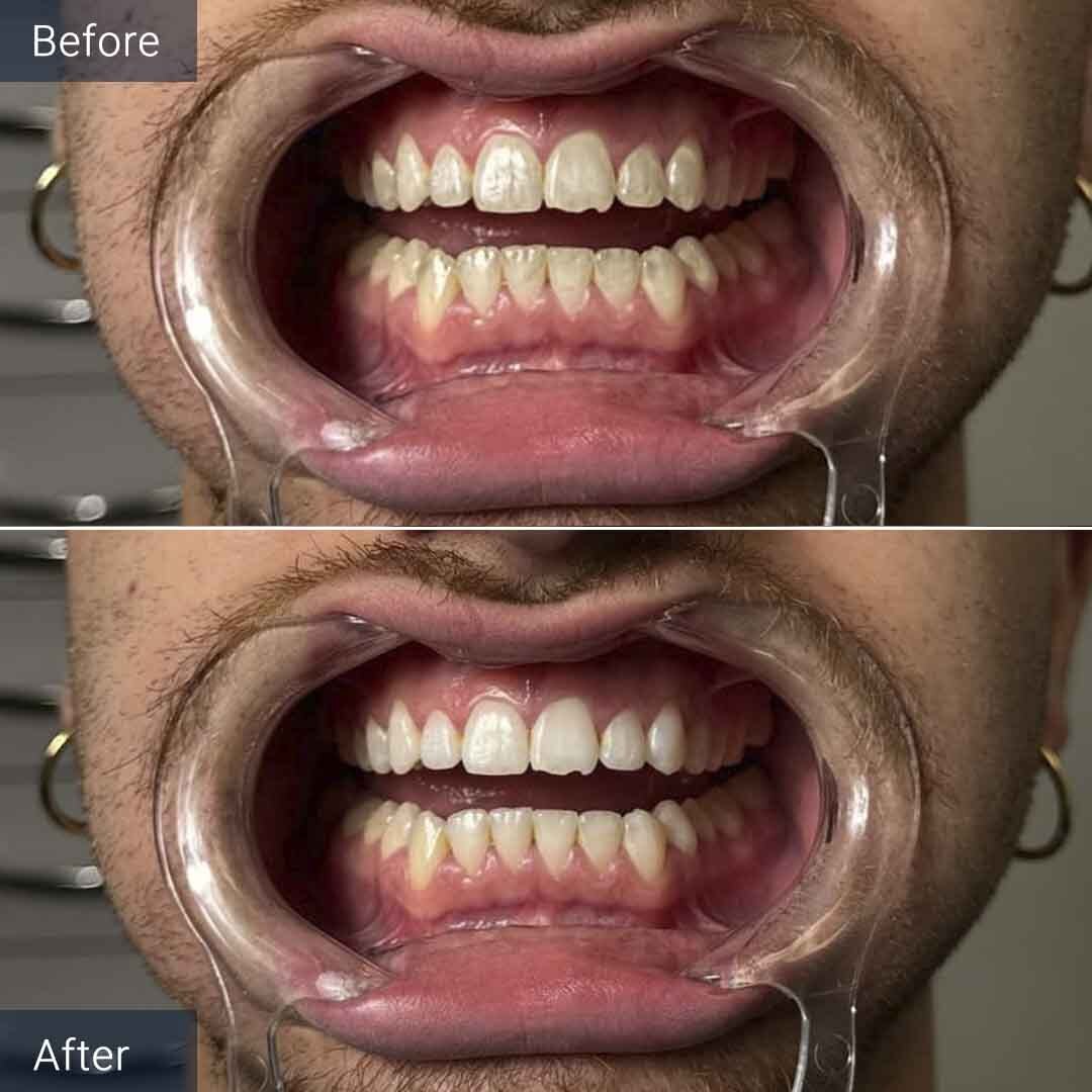 Air Flow Dental Cleaning Before and After North Miami Beach, FL