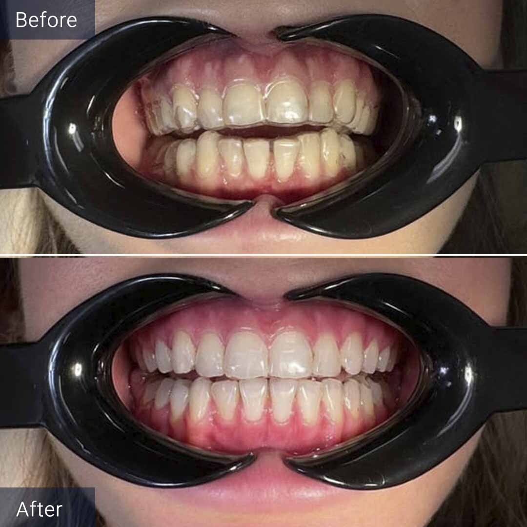 Clear Aligners Before and After North Miami Beach, FL