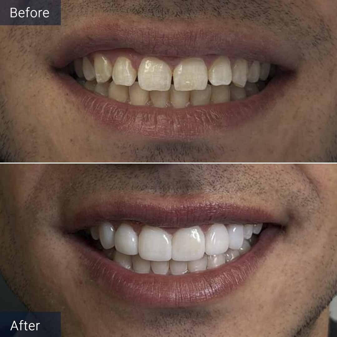 No-Prep Veneers Before and After North Miami Beach, FL