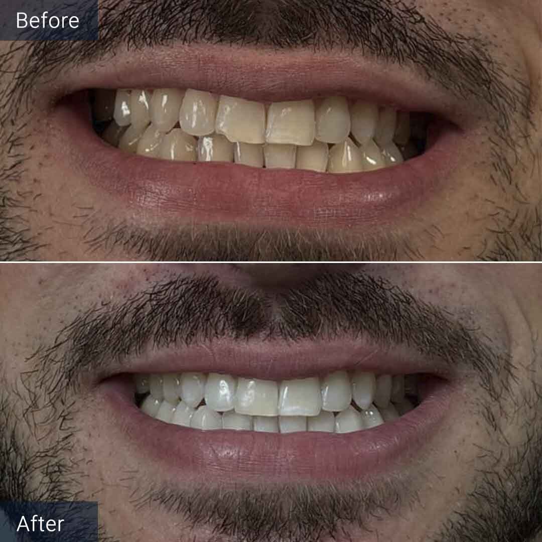 Teeth Whitening Before and After North Miami Beach, FL